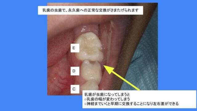 乳歯が虫歯になると永久歯への正常な交換が妨げられます はえかわり中の治療なら池田歯科医院